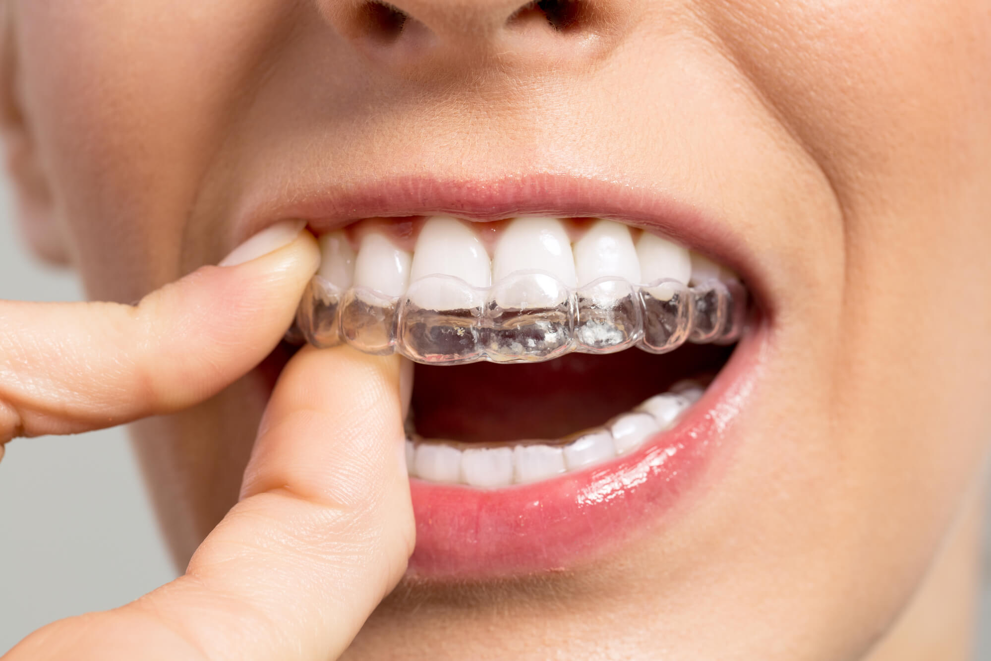 Quais os perigos do clareamento dentário caseiro sem orientação? - Blog