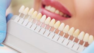 4 novidades para implantes dentários que você precisa saber