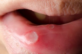 Câncer bucal: saiba como ocorre e previna-se!